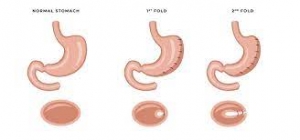 Dubai's Medical Marvel: The Science of Gastric Bypass
